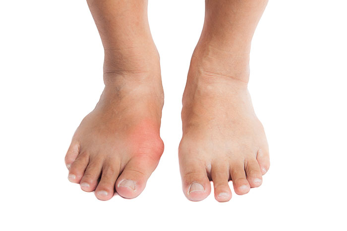 Arthritis treatment