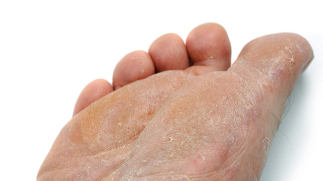 Athlete's foot treatment