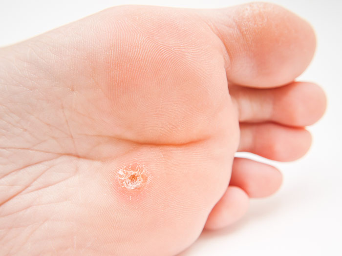 Verruca pedis treatment